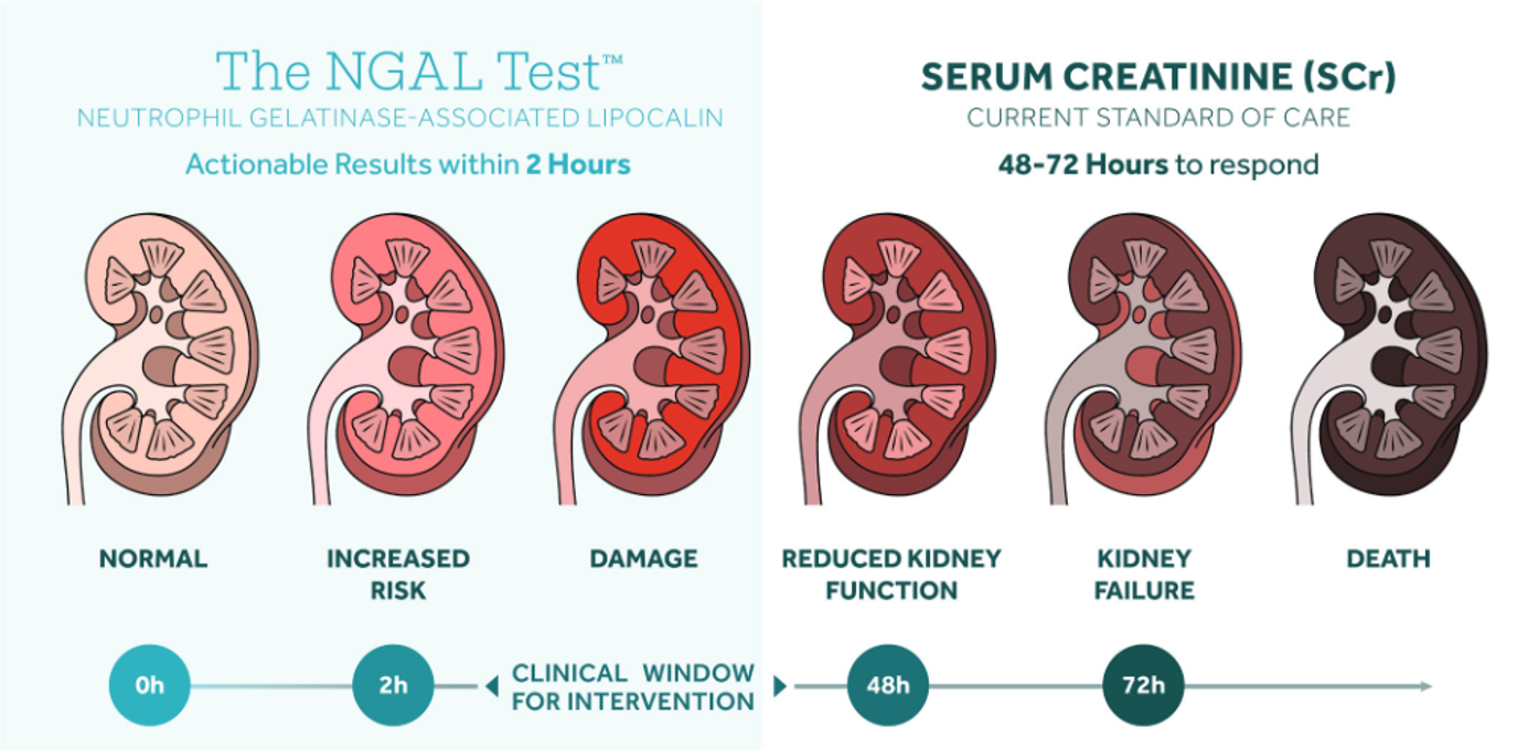 NGAL Test™检测试剂盒——Bioporto热销产品推荐