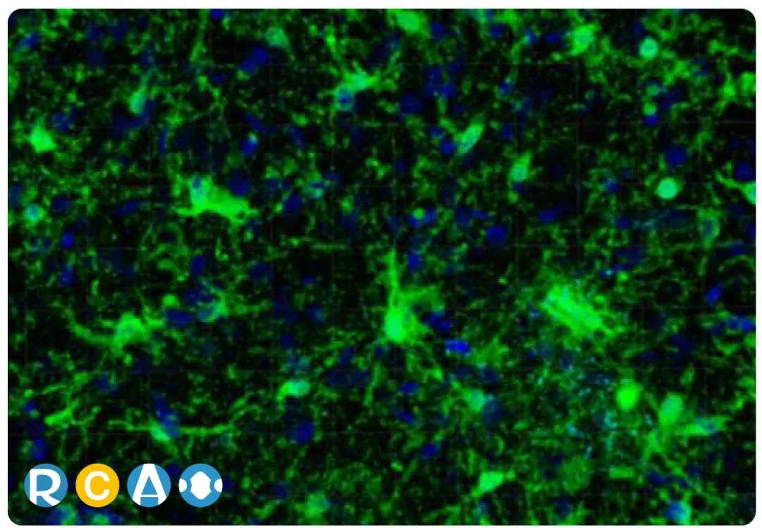 GFAP：星形胶质细胞活化标志物和新兴血清生物标志物